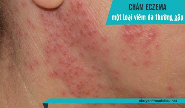 Chàm eczema cũng là một dạng bệnh viêm da chúng ta nên đề phòng