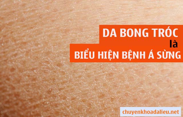 Da bong tróc là biểu hiện bệnh á sừng