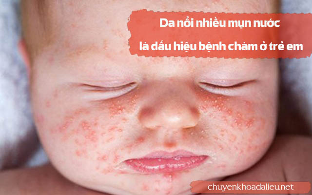 Da nổi nhiều mụn nước là dấu hiệu chàm ở trẻ em