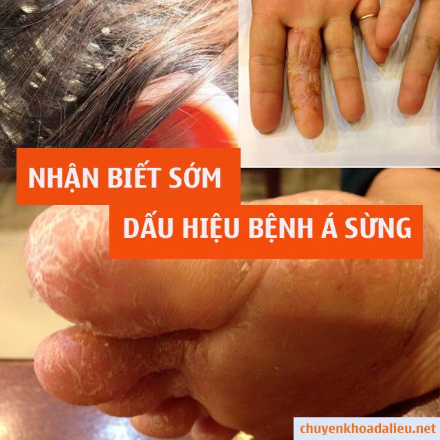 Dấu hiệu bệnh á sừng