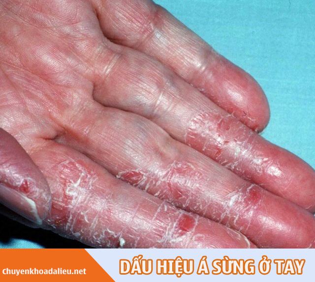 Dấu hiệu của bệnh á sừng ở tay