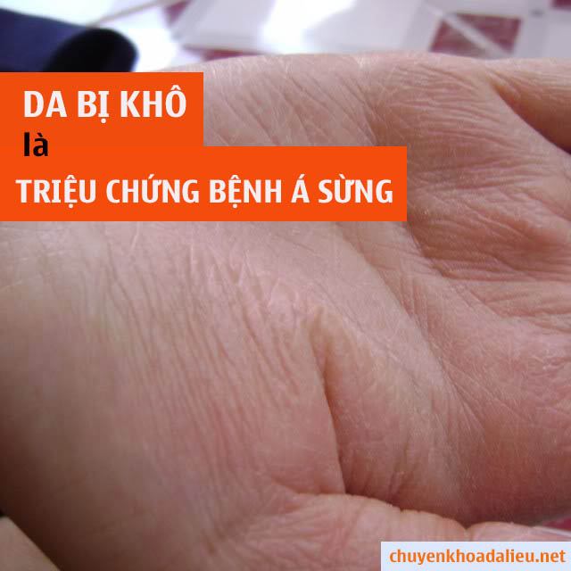 Da tay khô là triệu chứng bệnh á sừng