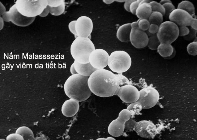 Nguyên nhân của bệnh viêm da tiết bã do nấm Malasssezia