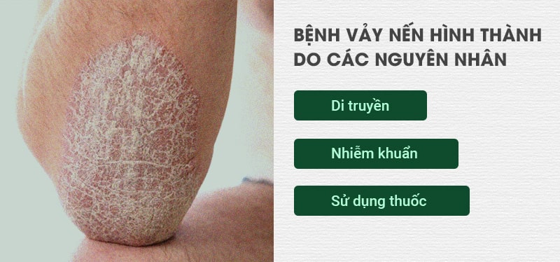 Bệnh vảy nến