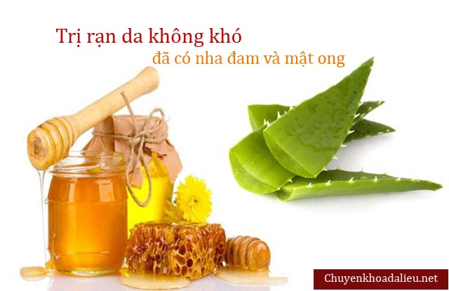 Thuốc chữa rạn da từ nha đam và mật ong