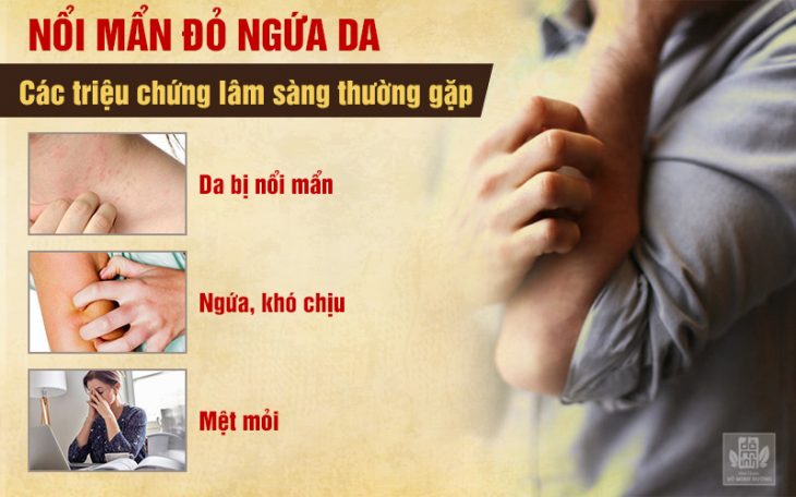 Biểu hiện nổi mẩn đỏ dị ứng ngứa da lâm sàng 