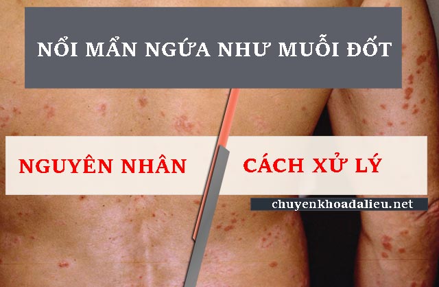 nổi mẩn ngứa khắp người như muỗi đốt nguyên nhân và cách điều trị