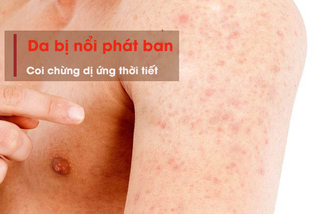 Da bị nổi phát ban là triệu chứng dị ứng thời tiết điển hình nhất