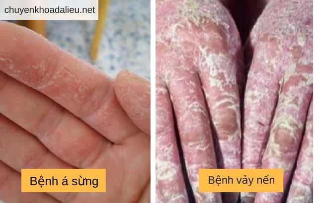 Phân biệt bệnh á sừng và bệnh vẩy nến