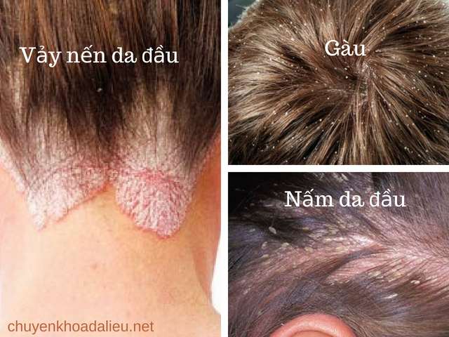 Phân biệt bệnh vẩy nến da đầu với gàu và nấm da đầu