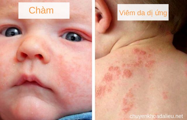 Phụ huynh cần nắm bắt các dấu hiệu bệnh và phân biệt