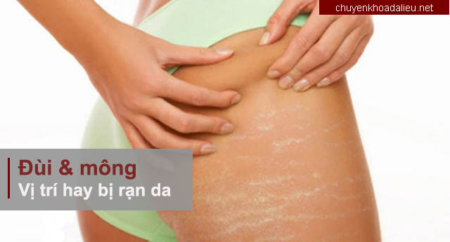 Rạn da ở đùi và mông