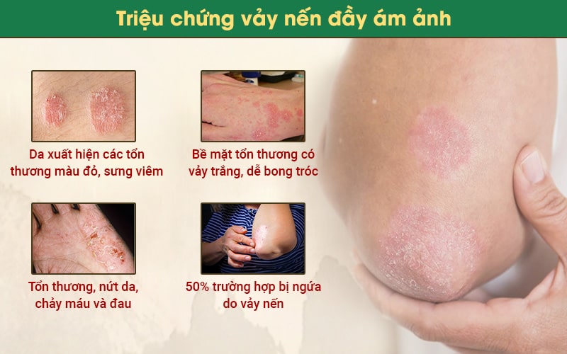 Bệnh vảy nến