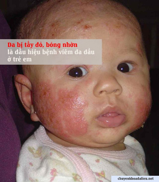 Triệu chứng bệnh viêm da dầu ở trẻ em