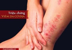 triệu chứng bệnh viêm da cơ địa