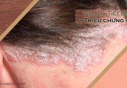 nhận biết các triệu chứng viêm da tiết bã