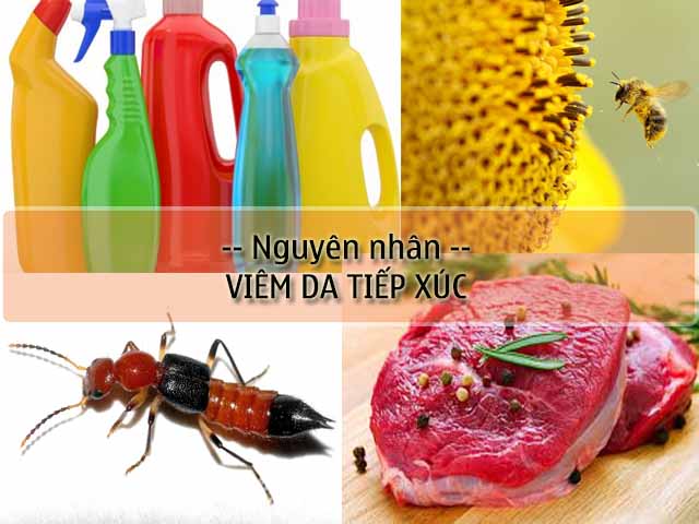 nguyên nhân gây viêm da tiếp xúc