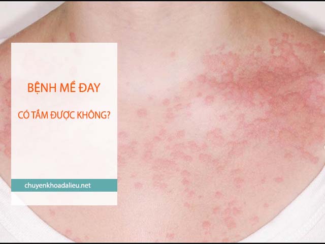 bệnh mề đay có tắm được không