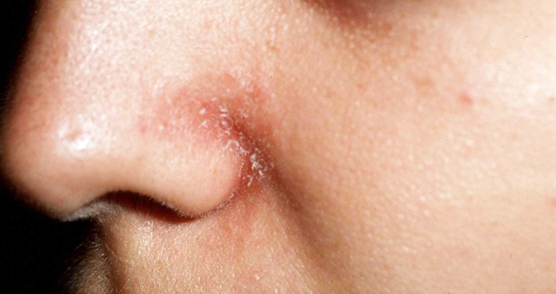 Bệnh viêm da dầu ở cánh mũi tương đối phổ biến
