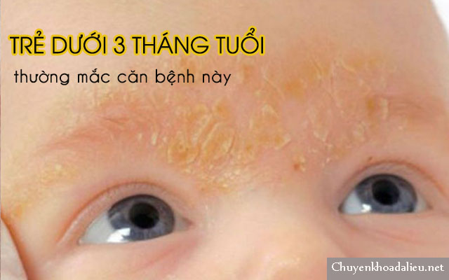 Viêm da tiết bã nhờn ở mặt thường ảnh hưởng đến trẻ sơ sinh dưới 3 tháng tuổi