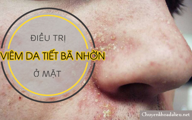 Bệnh viêm da tiết bã nhờn ở mặt