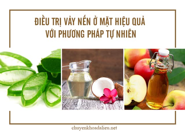 phương pháp tự nhiên chữa vảy nến ở mặt