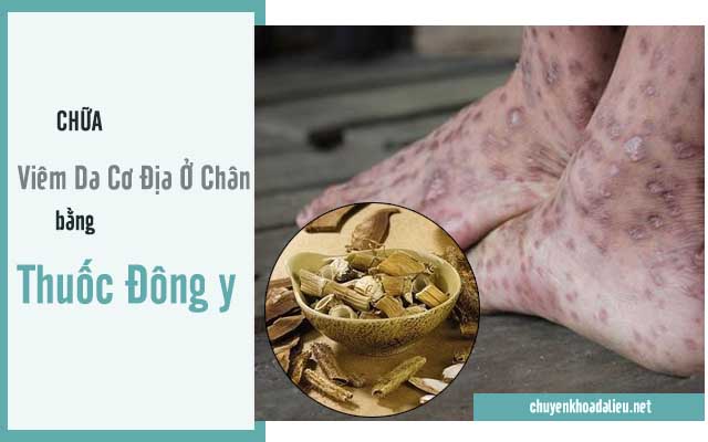 trị viêm da cơ địa ở chân bằng thuốc đông y