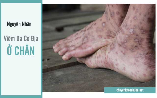 Một số nguyên nhân chính gây ra viêm da cơ địa ở chân