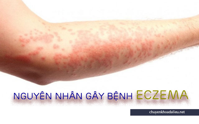 Nguyên nhân bệnh Eczema phổ biến