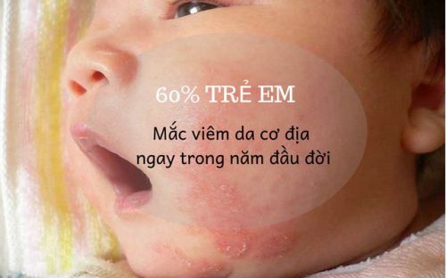 Theo thống kê có khoảng 60% trẻ em mắc viêm da cơ địa