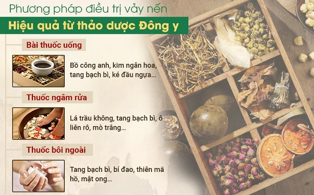 Chữa vảy nến hiệu quả và an toàn từ thảo dược