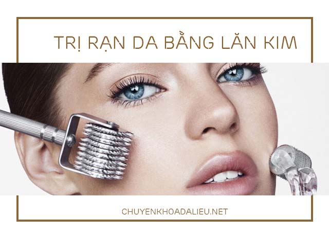 Trị rạn da bằng lăn kim tại nhà