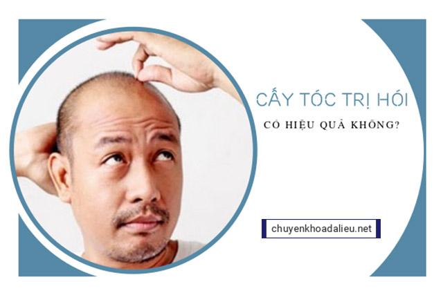 Cấy tóc trị hói hiệu quả không