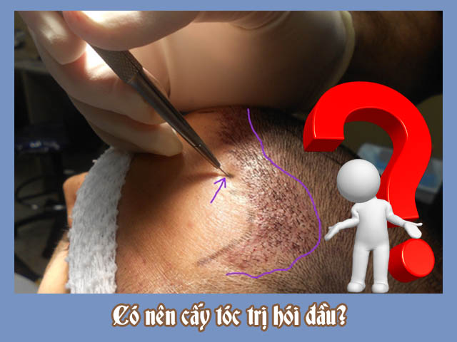 Có nên cấy tóc trị hói đầu không?