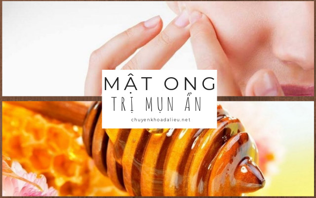 mật ong trị mụn ẩn