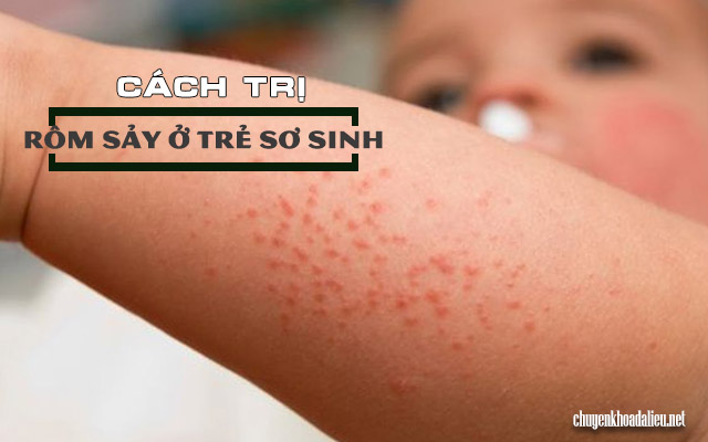 cách trị rôm sảy cho trẻ sơ sinh