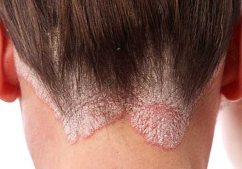 Triệu chứng của bệnh vảy nến da đầu