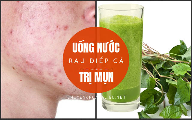 uống nước rau diếp cá trị mụn