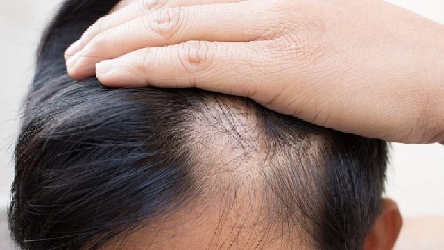 Hành trình phục hồi mái tóc dày của chàng trai có nguy cơ hói đầu 1