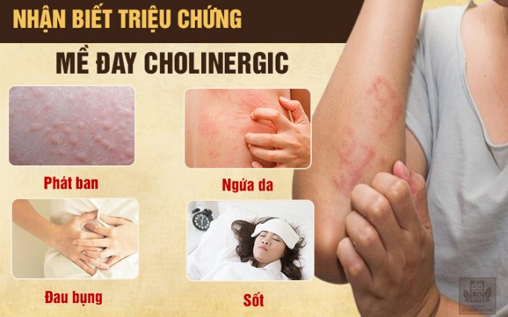 Sóm phát hiện dấu hiệu bệnh nổi mề đay cholinergic để chữa trị kịp thời