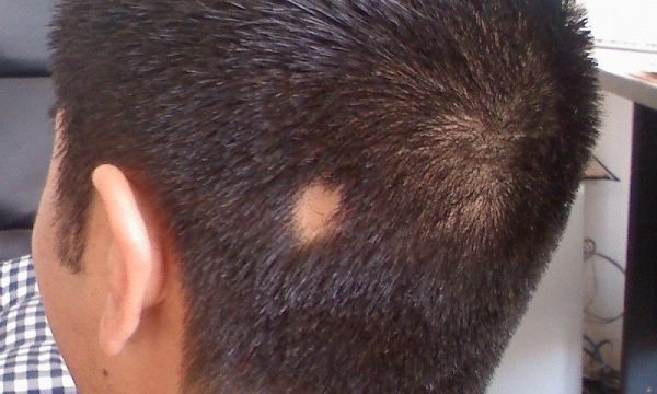 Các nguyên nhân gây rụng tóc từng mảng alopecia areata  Vinmec