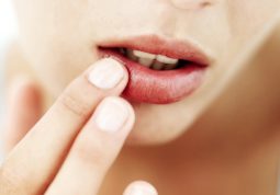 Tìm hiểu các biểu hiện của bệnh chàm môi và cách điều trị