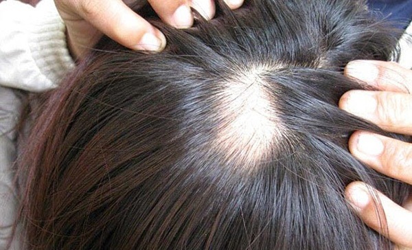 Bổ huyết Tiêu giao thang - Giải pháp hiệu quả cho bệnh lý rụng tóc