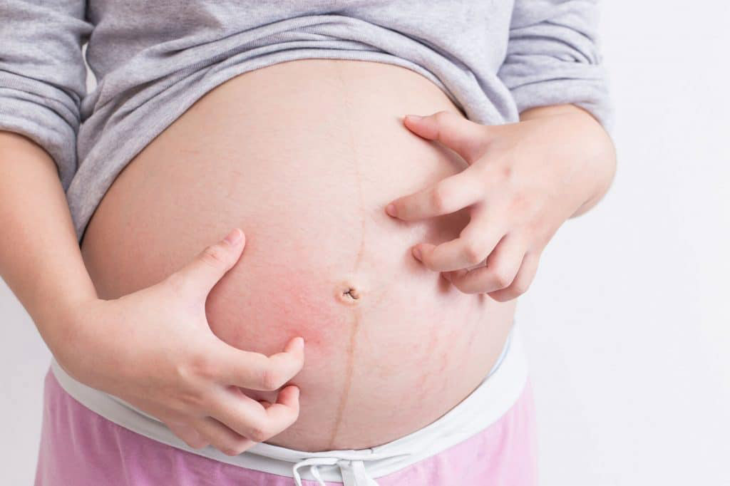 triệu chứng bệnh chàm khi mang thai