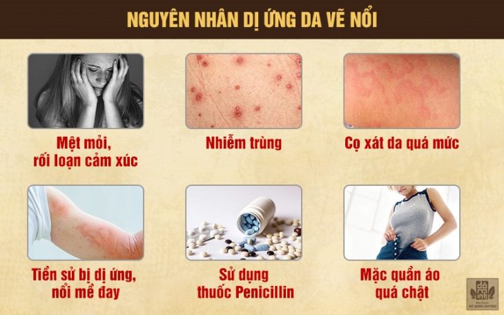 6 yếu tố gây dị ứng da vẽ nổi phổ biến