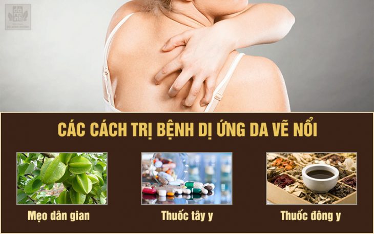 Chạm nhẹ cũng nổi mẩn đỏ trên da VnExpress Sức khỏe #44 Chạm nhẹ cũng nổi mẩn đỏ trên da VnExpress Sức khỏe