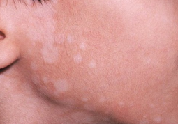 Nổi nốt trắng trên da có thể là dấu hiệu của nhiều bệnh nguy hiểm