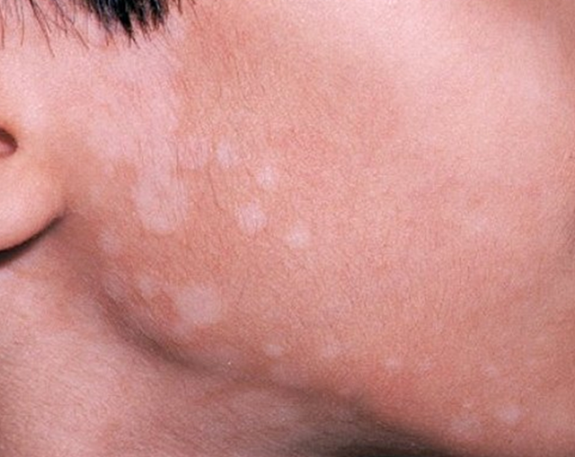 Nổi nốt trắng trên da có thể là dấu hiệu của nhiều bệnh nguy hiểm 