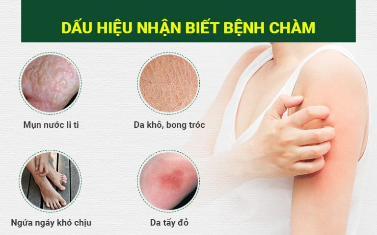 Hình ảnh bệnh chàm và dấu hiệu nhận biết