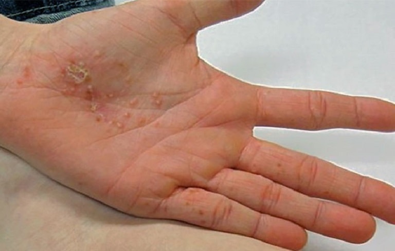 Bệnh tổ đỉa bàn tay gây đau đớn bất tiện trong sinh hoạt, công việc